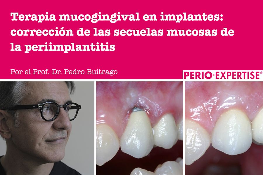 Terapia mucogingival en implantes dentales