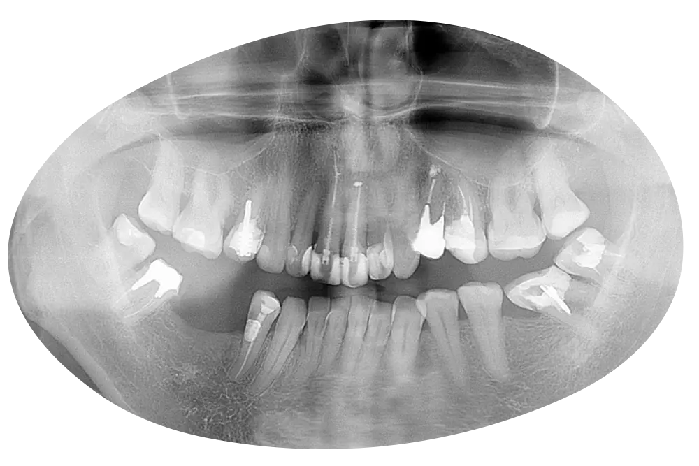 Prótesis dentales en Valencia