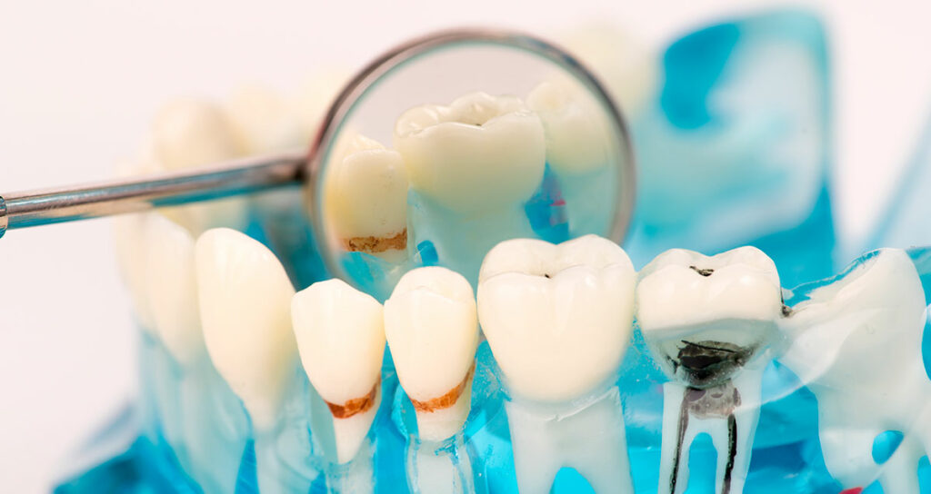 Caries - Placa dental